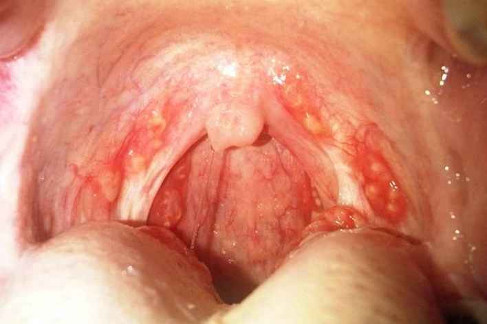 Bumps In The Back Of The Throat 104