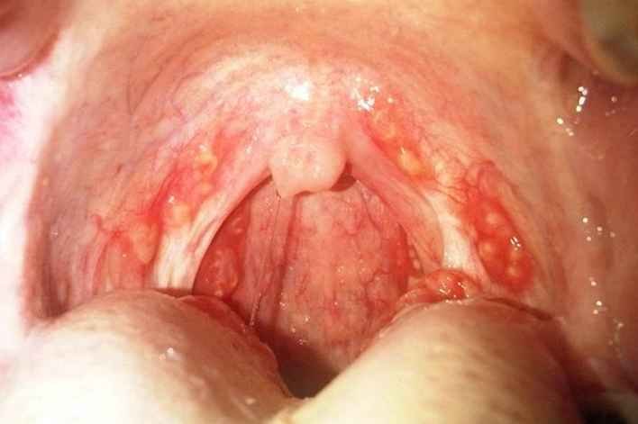 Red Spot In Throat 21