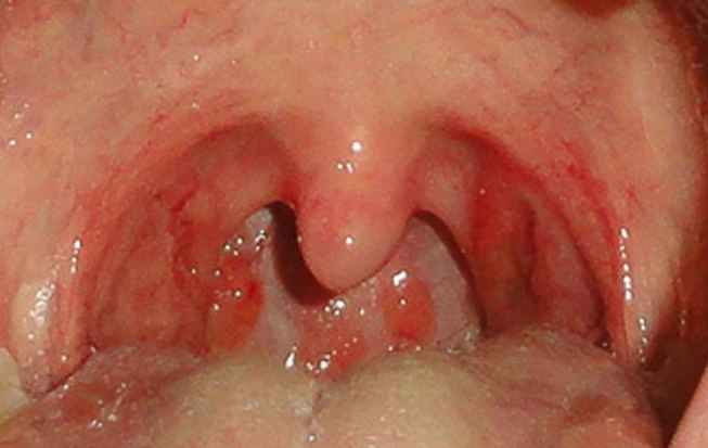 White Bump On Throat 78