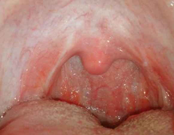 Hair In Back Of Throat 46