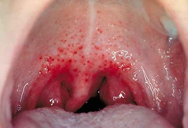 Bumps On Back Of The Throat Causes Treatment And Pictures