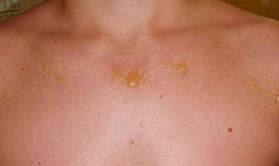 table-of-content-what-is-sun-poisoning-rash-sun-poisoning-rash