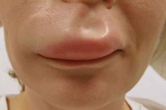 swollen upper lip from insect bites
