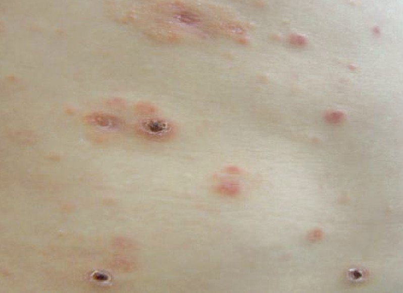 pityriasis-lichenoides-pictures-causes-symptoms-treatment