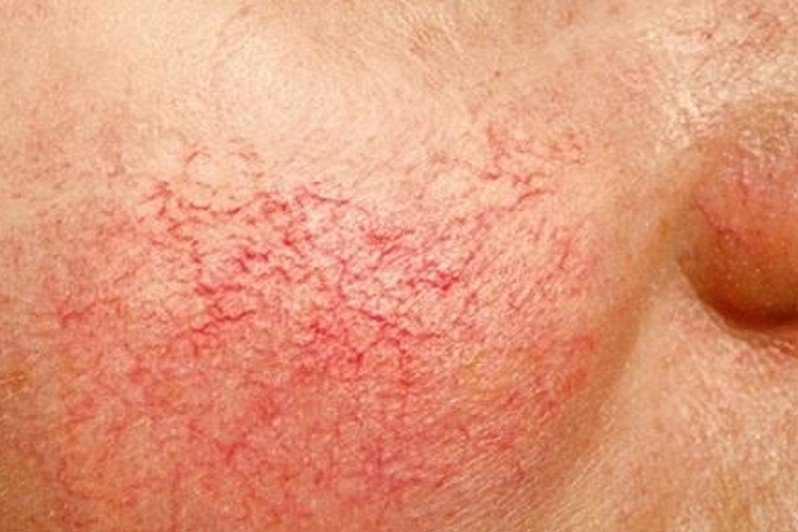 Telangiectasia Treatment Pictures Symptoms Causes 