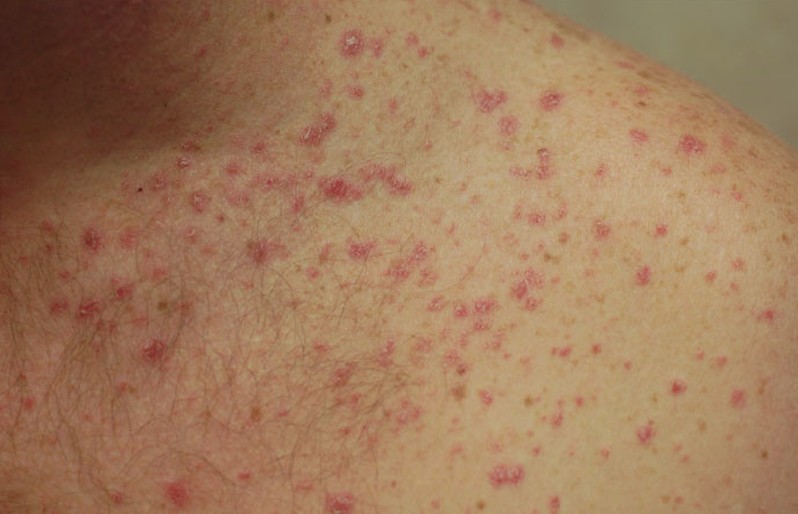 can amoxicillin cause skin rash