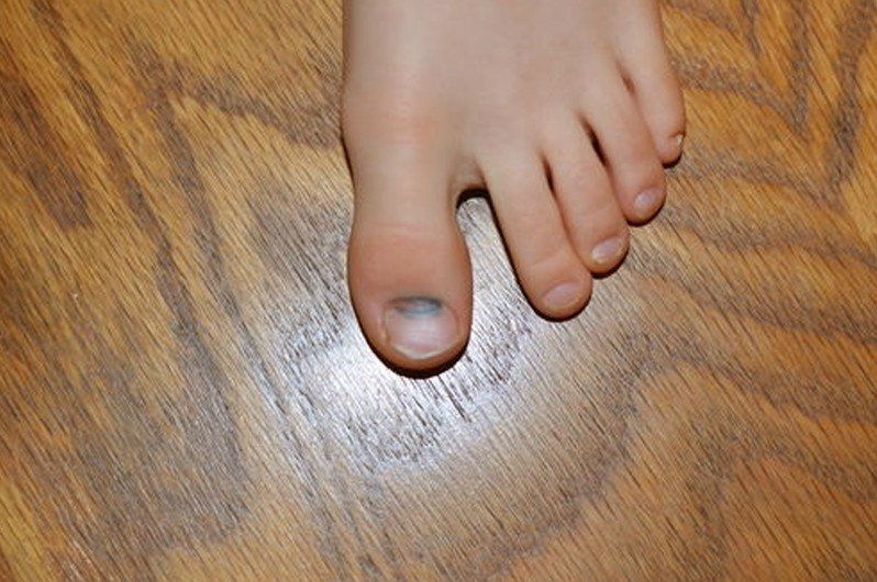 Bruised Toenail Pictures Healing Time Causes Treatment