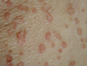 Porokeratosis - Treatment, Pictures, Symptoms and Causes