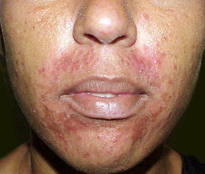 pimples around mouth - pictures, photos