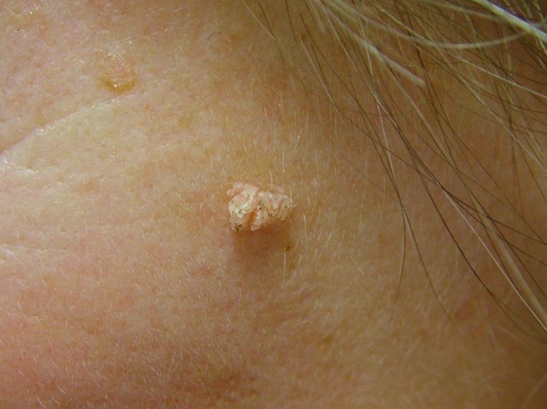 Filiform Warts - Pictures, Causes, Treatment, Contagious