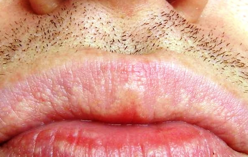 Fordyce Spots on Lips - Causes, Pictures, Contagious, Removal