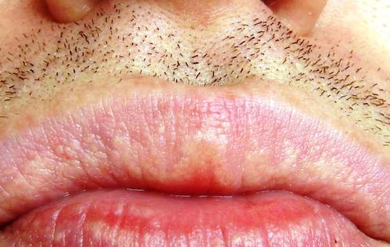 Fordyce Spots On Lips Causes Pictures Contagious Removal