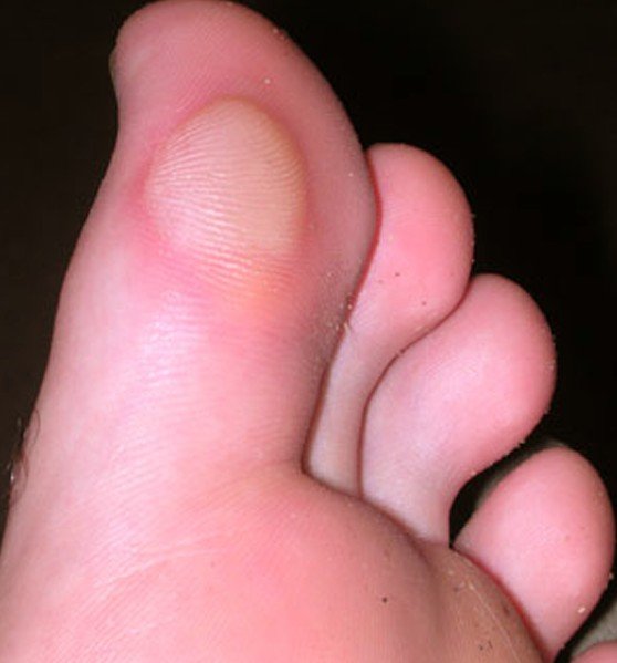 Blisters On Toes Pictures Causes And Treatment 6120