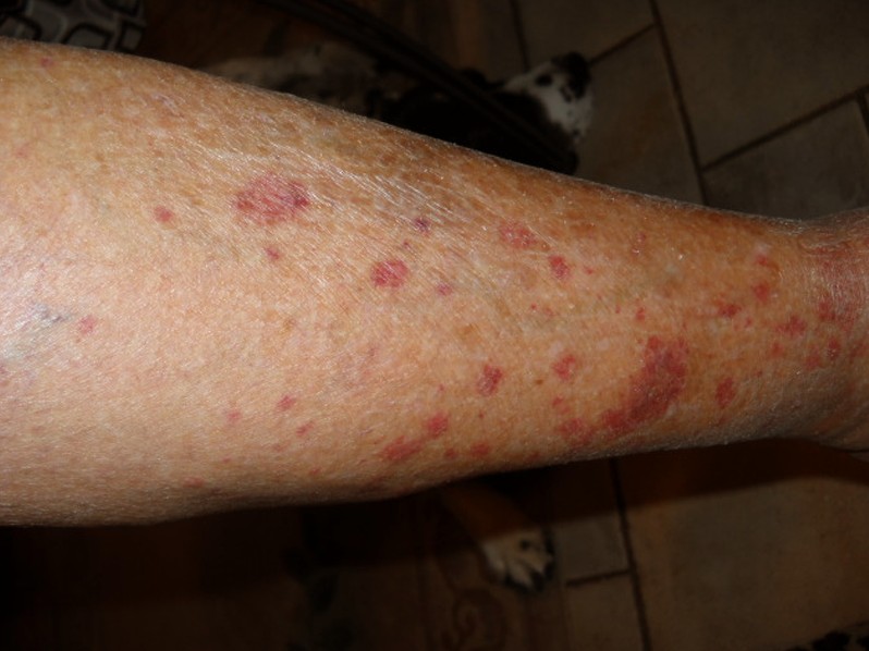 bright red dots on lower legs