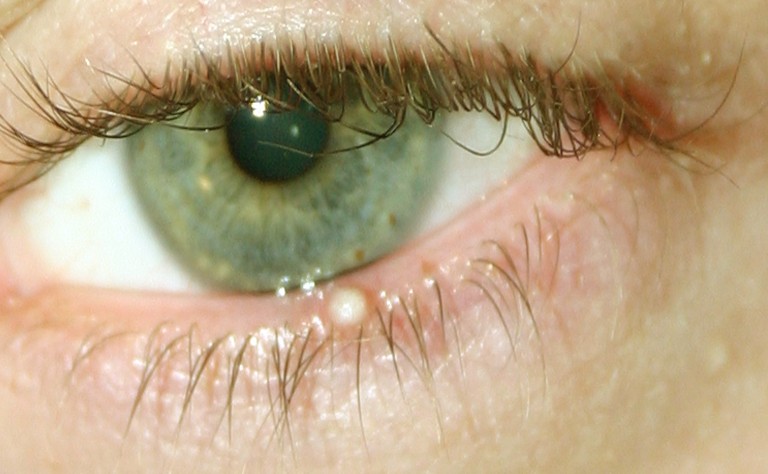 What Causes White Bump On Eyelid Easy Tips And Treatm - vrogue.co