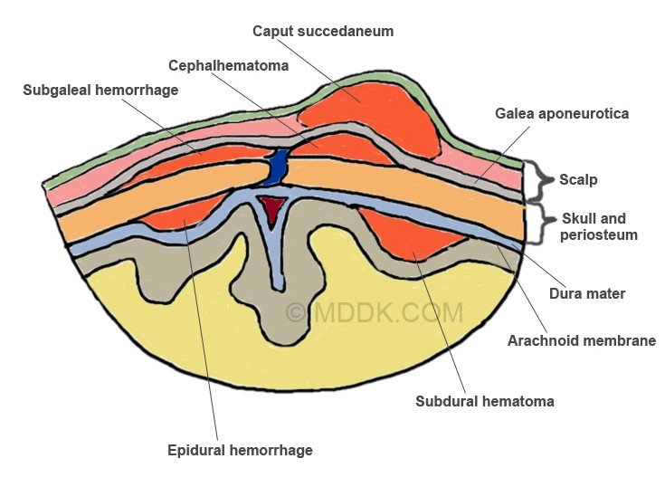 Hominick Hematoma